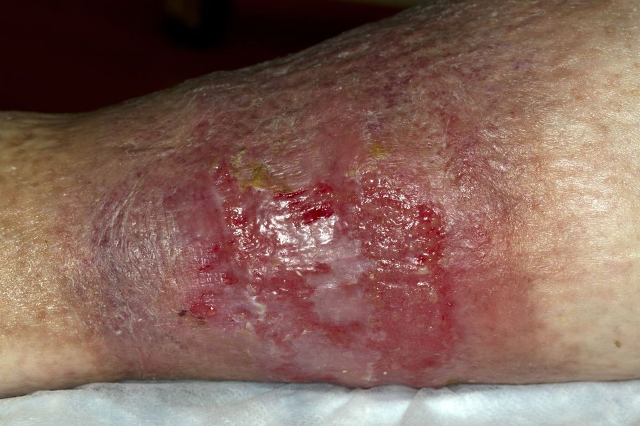 Venous Stasis Ulcer