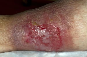 Loét tĩnh mạch do ứ trệ