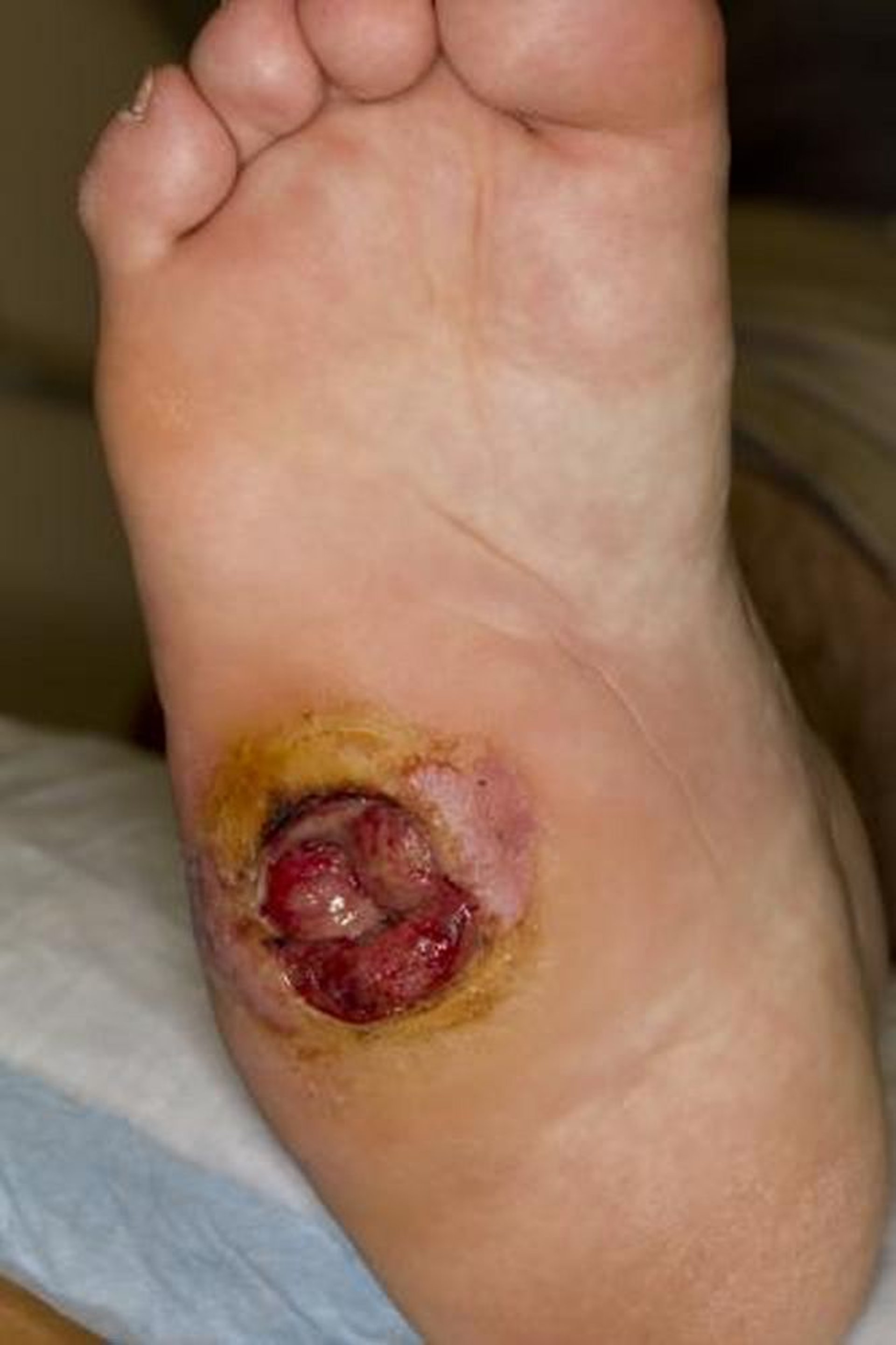 Tổn thương do tì đè giai đoạn 3 (bàn chân)