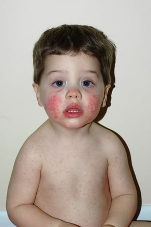 Bệnh ban đỏ nhiễm khuẩn (Erythema Infectiosum)
