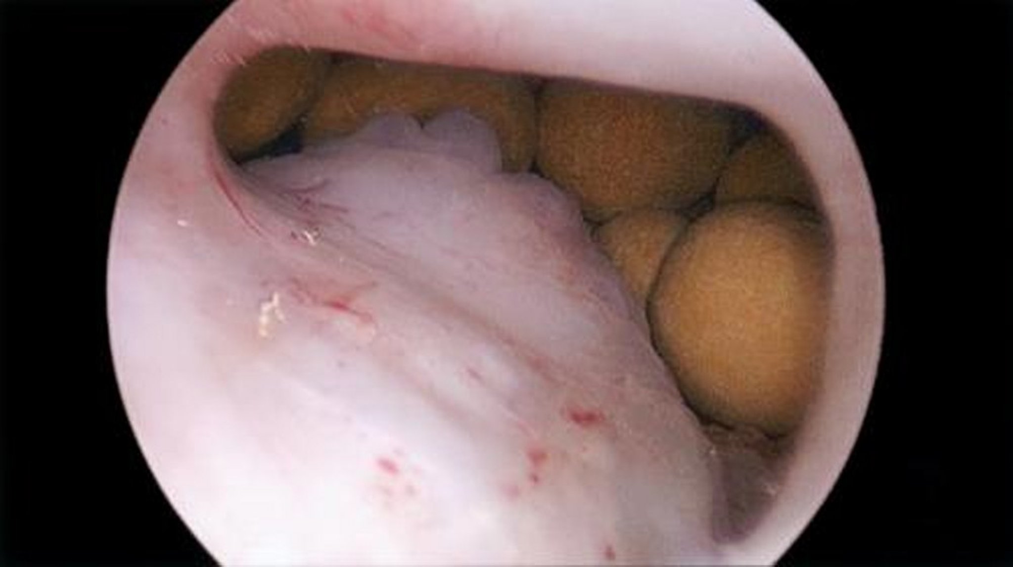 Cystoscopy (Bladder Stones)