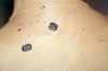 Seborrheic Keratoses (Back)
