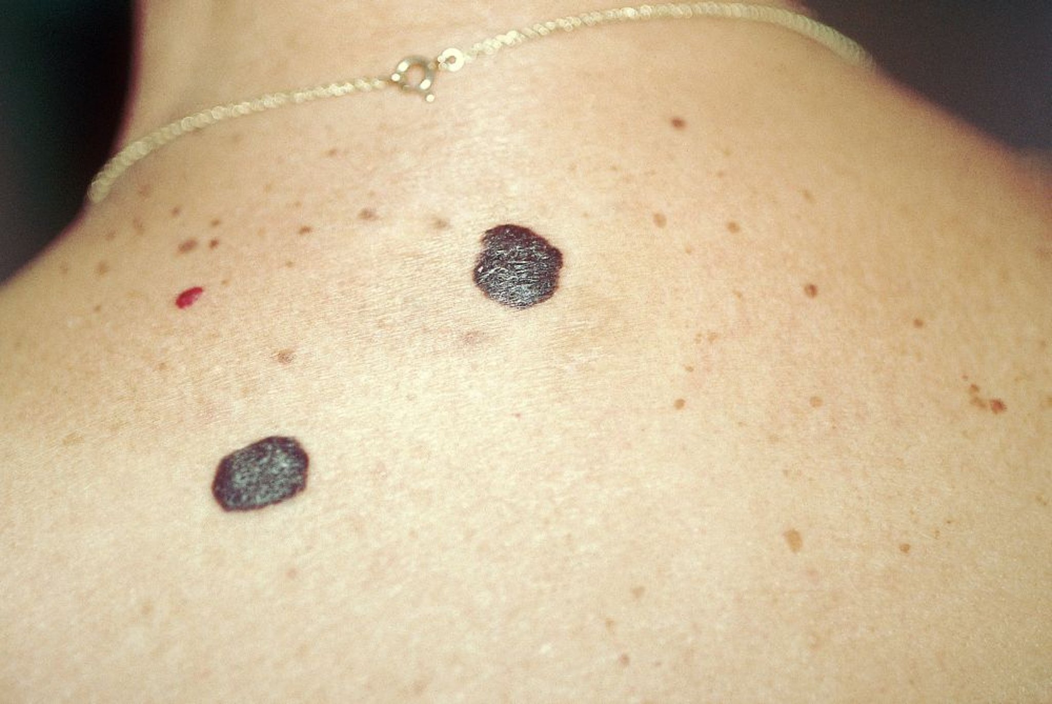 Себорейный кератоз (спина)