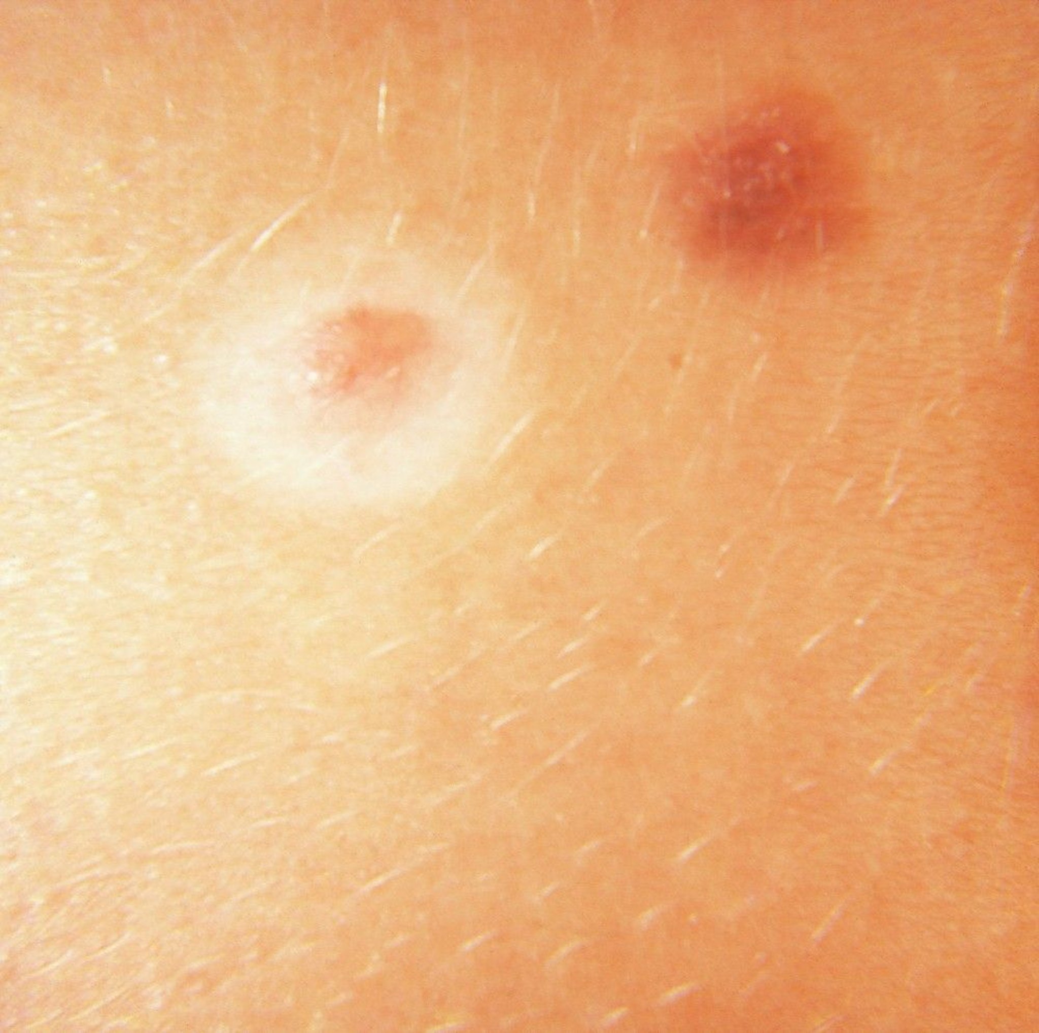 Halo Nevus