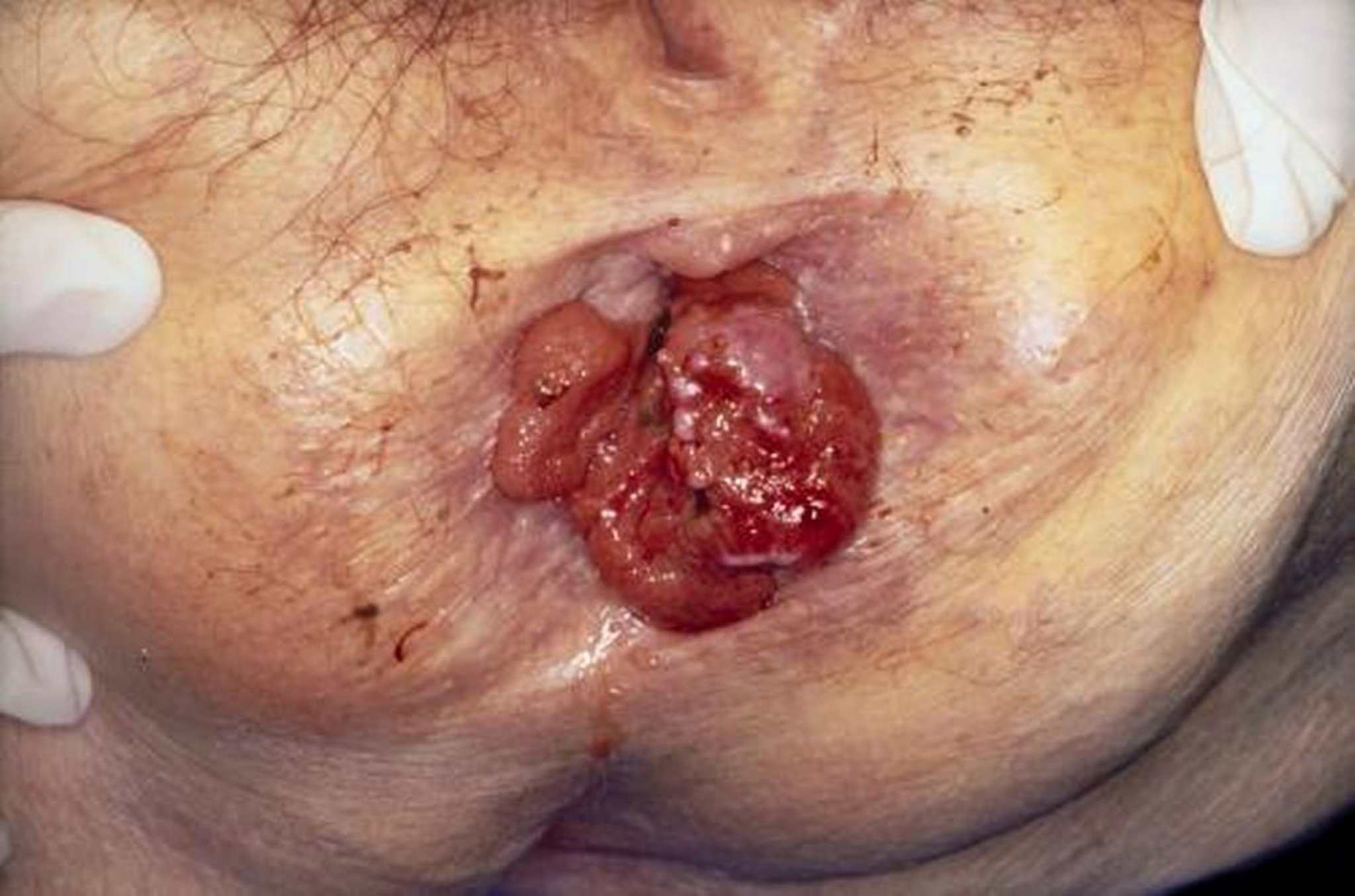 Рак анального канала