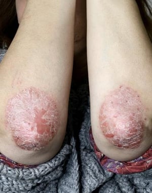 Psoriasis (coudes)