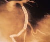 Intervención coronaria por vía percutánea
