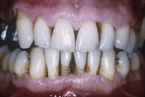 Periodontitis (pérdida de los tejidos de sostén del diente)