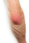 Bursitis del olécranon