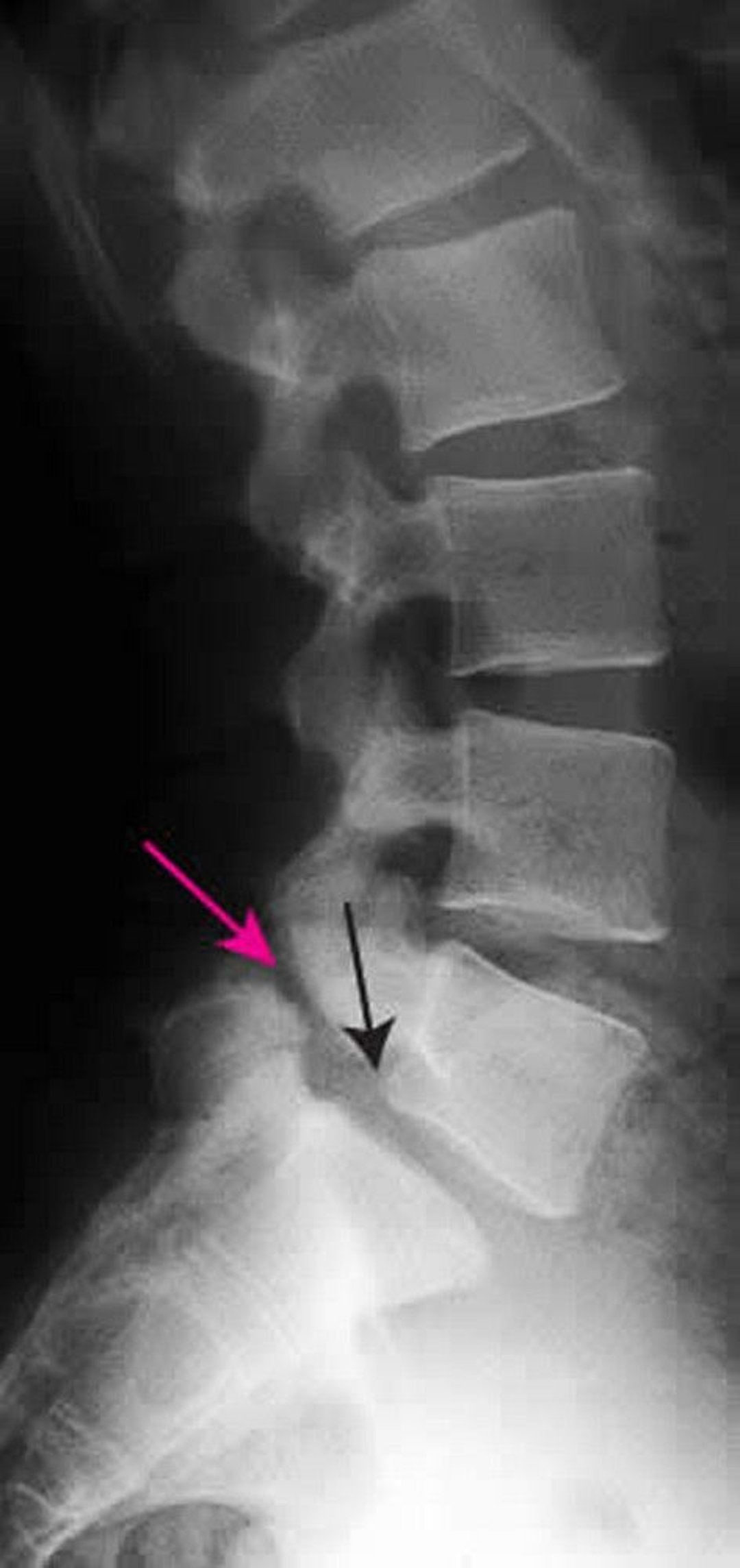 spondylolisthesis cervical spine symptoms