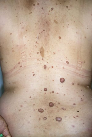 Neurofibrome und Café-au-Lait-Flecken