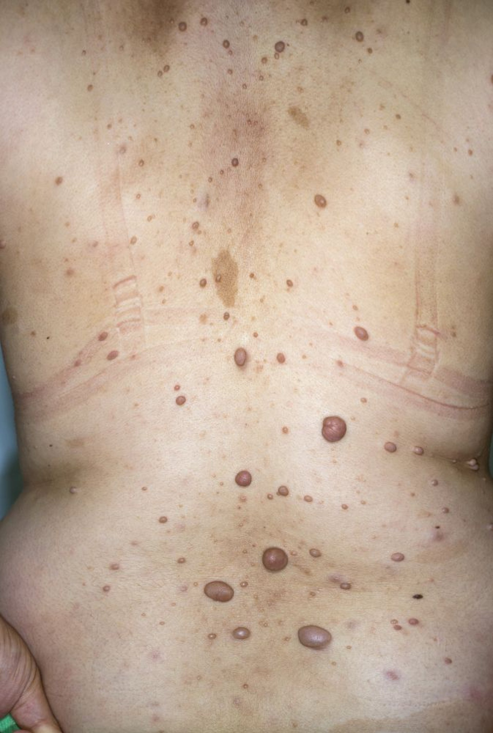 Neurofibromas y manchas de café con leche