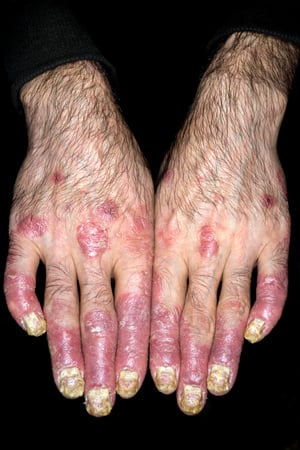 乾癬（手指）