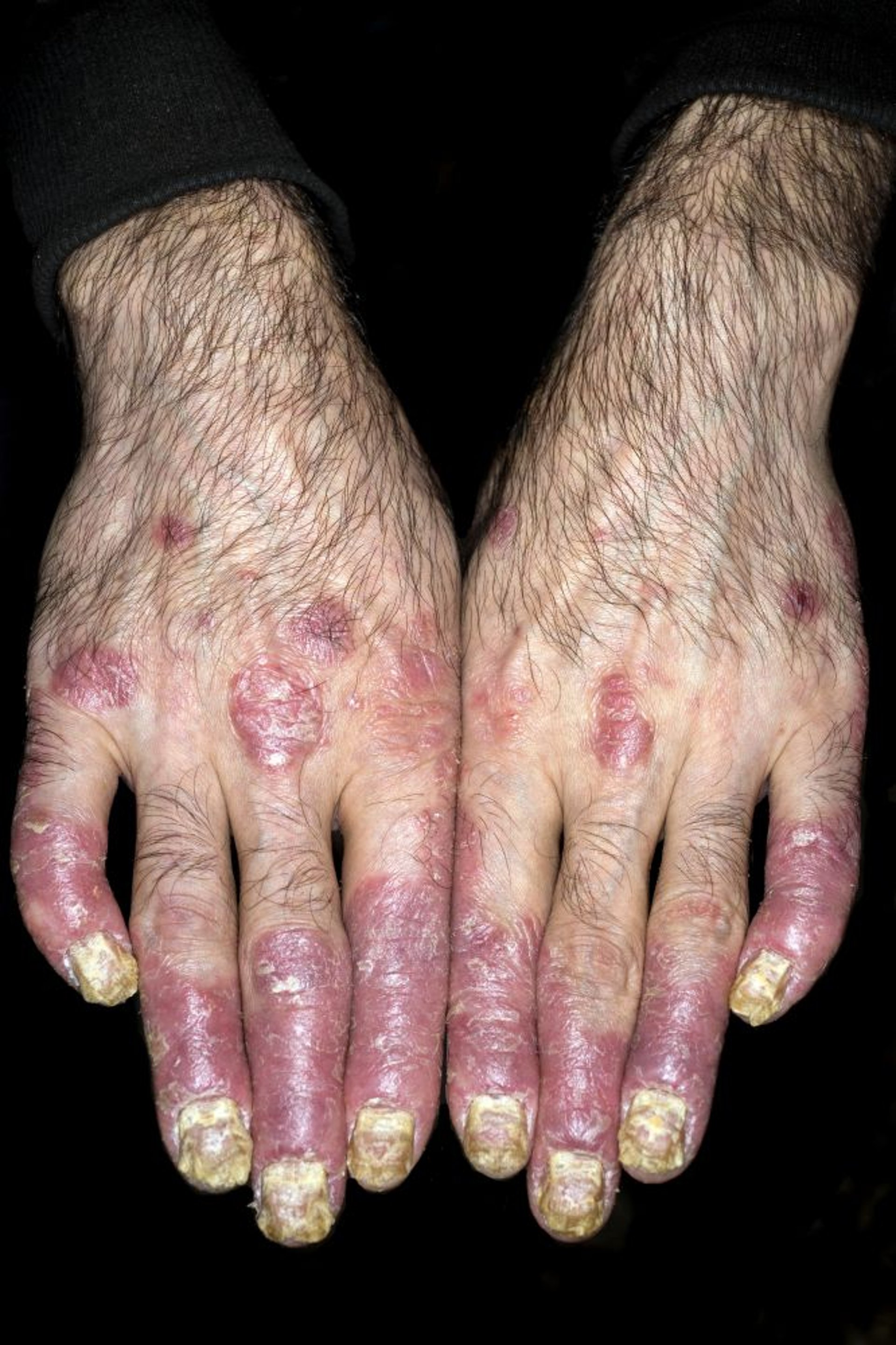 Psoriasis (Fingers)