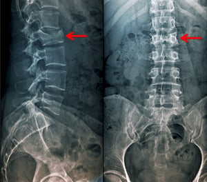 Anteroposterior and Lateral View of a Compression Fracture