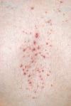 Erupção acneiforme