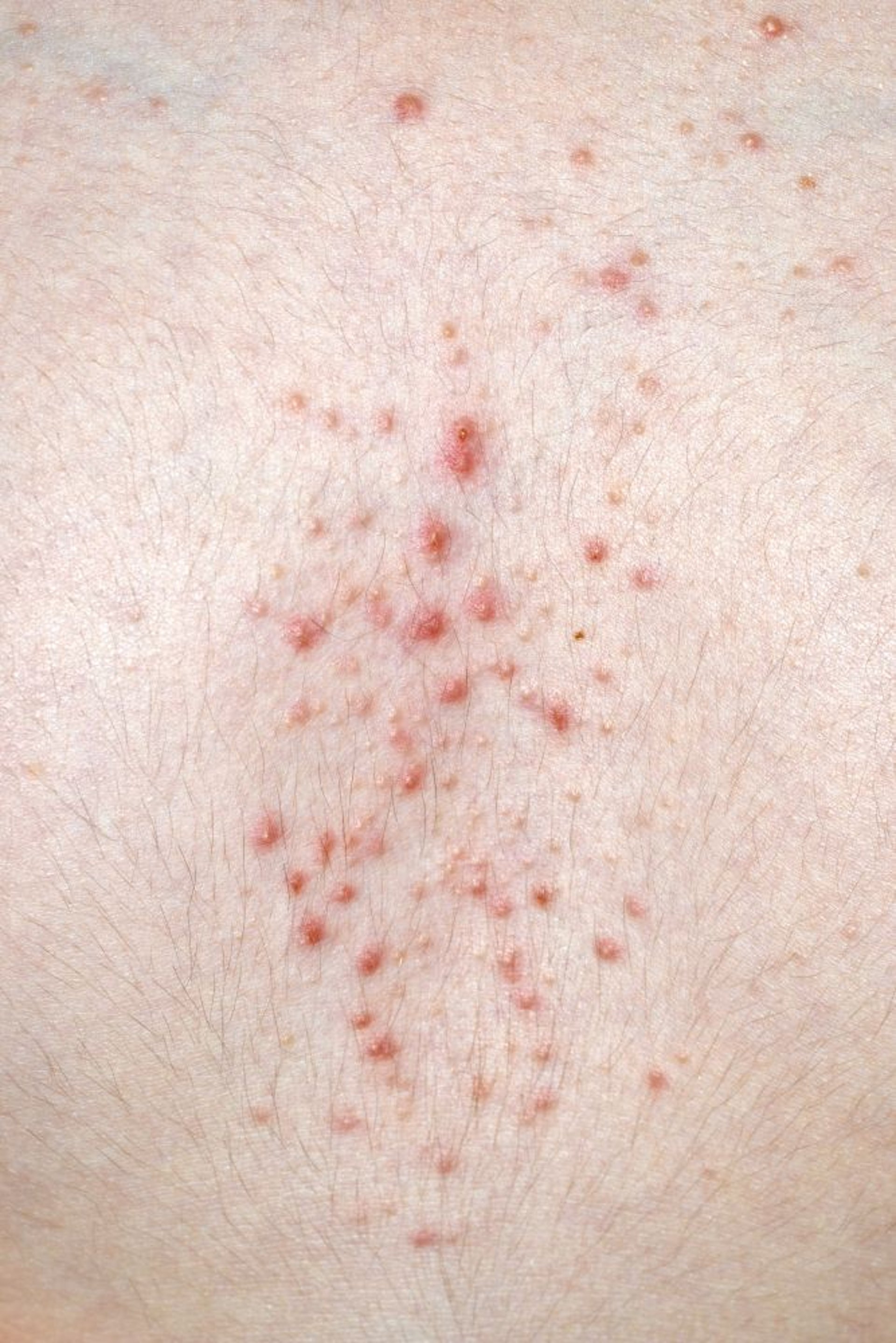 Erupção acneiforme