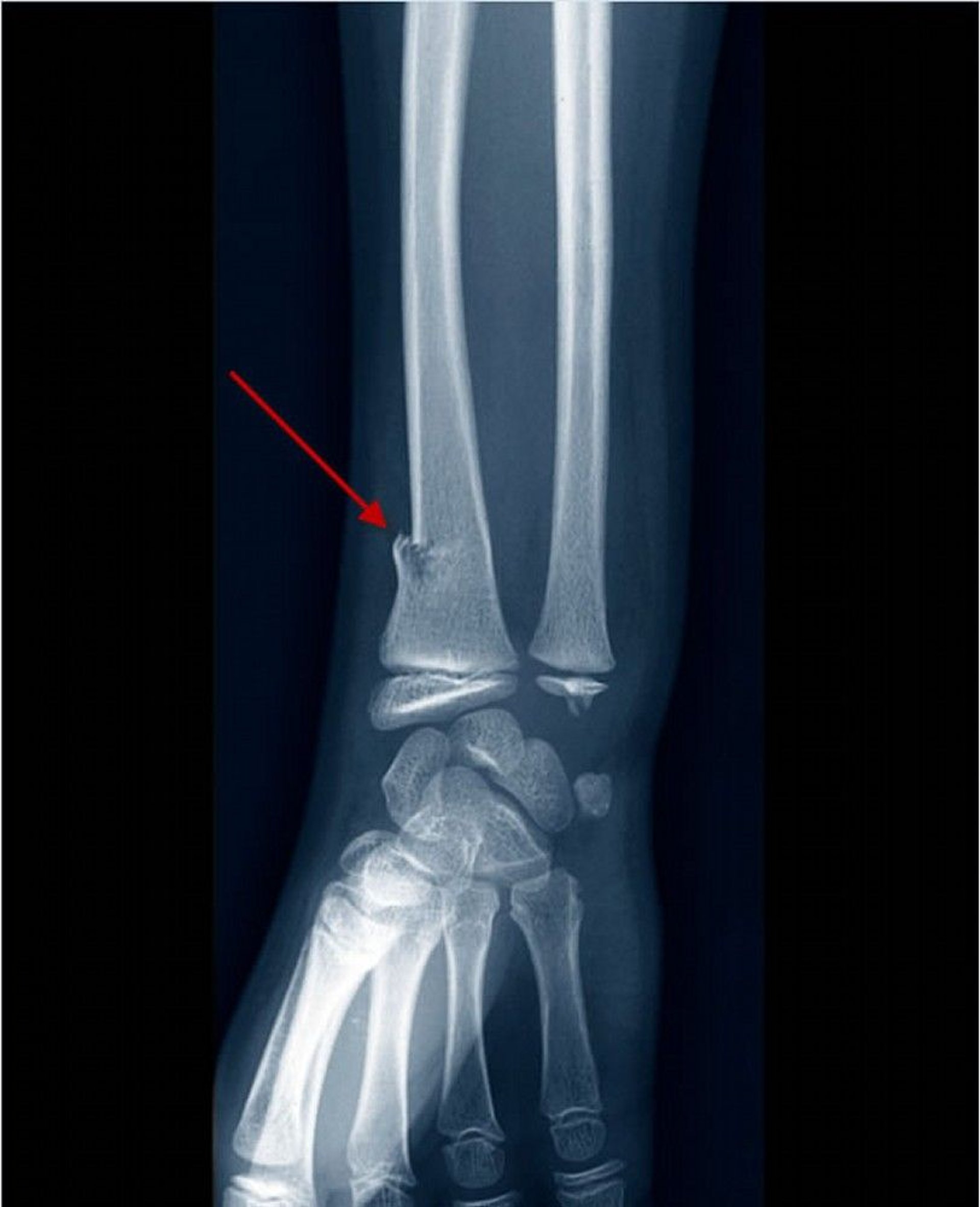 Greenstick Fracture of the Distal Radius