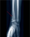 Fracture en bois vert du radius distal