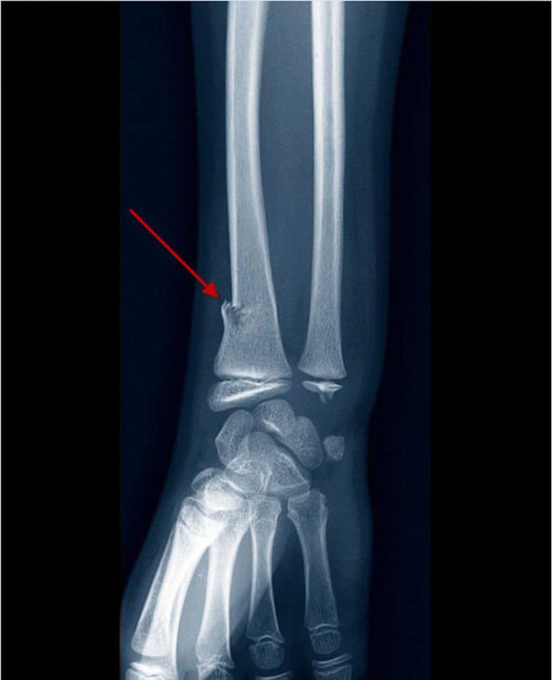 Fracture en bois vert du radius distal