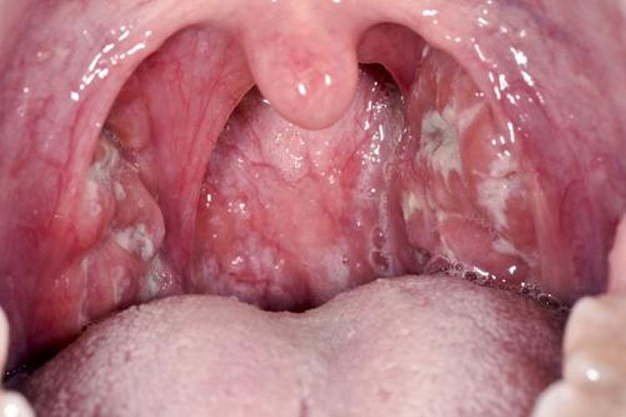 Streptococcal Pharyngitis