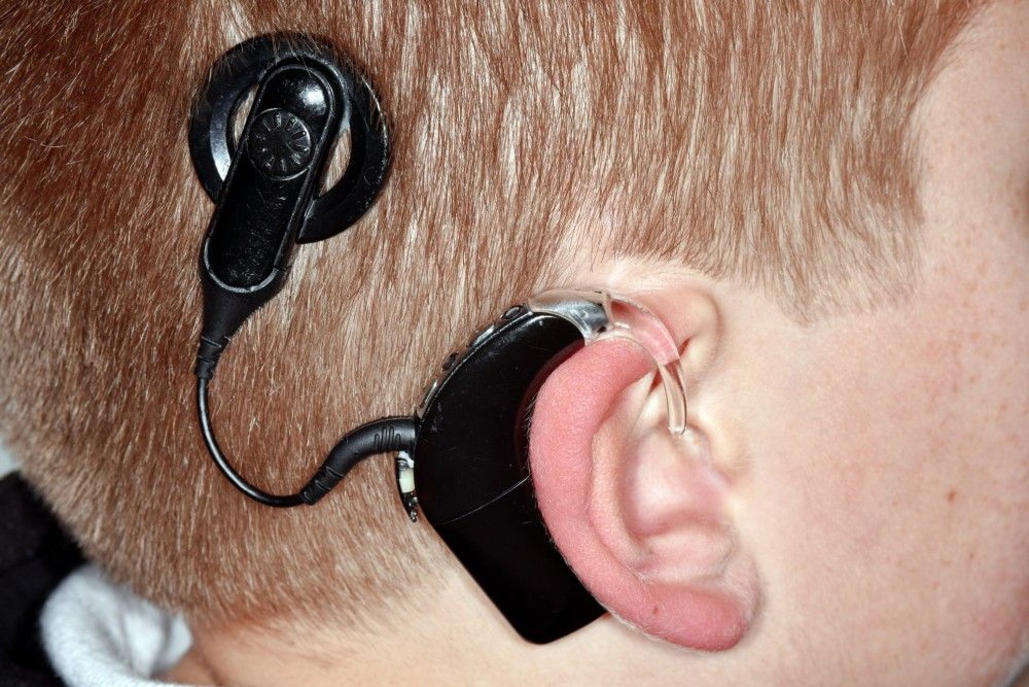 Cochlear Implant (Child)