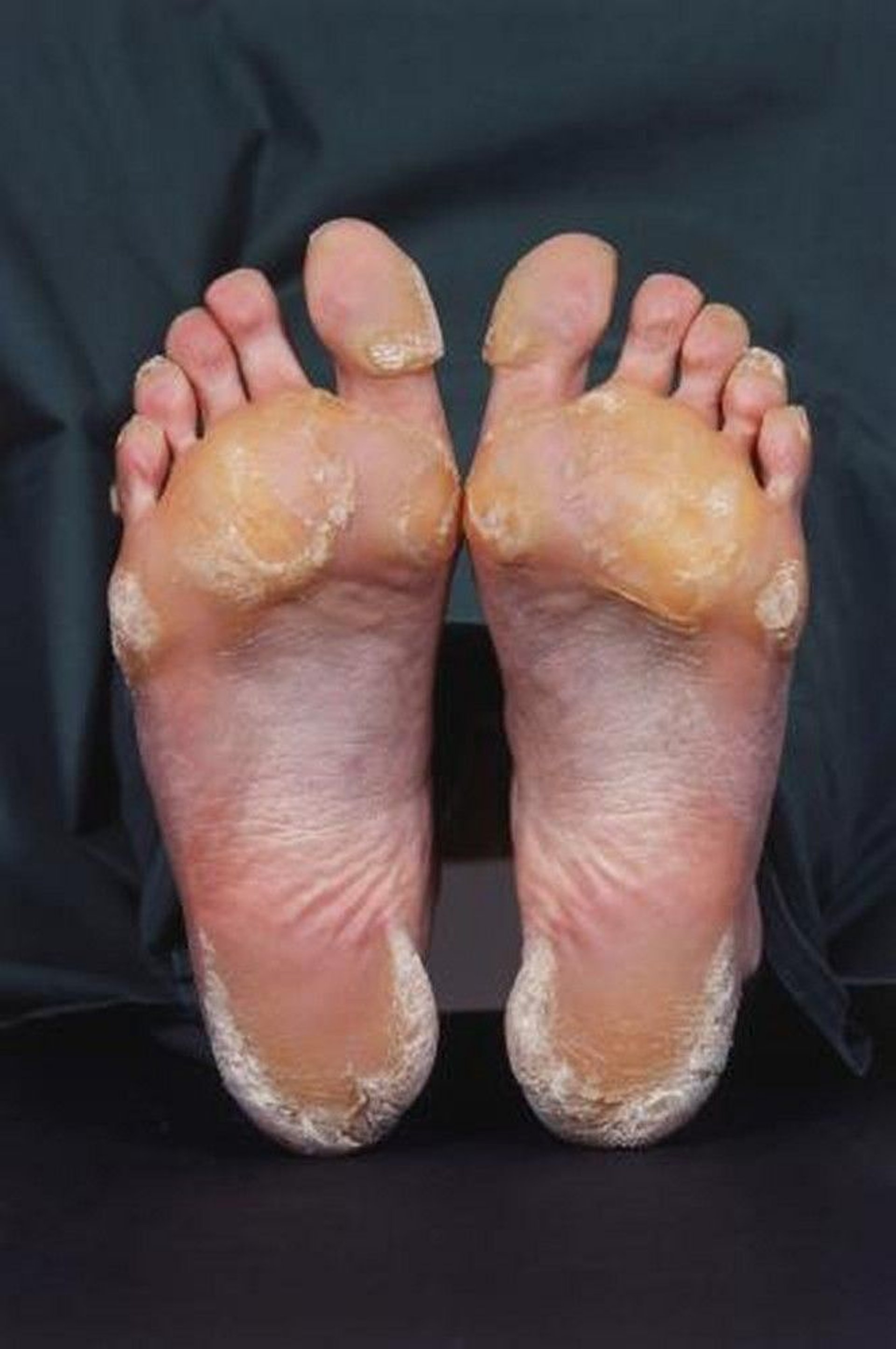 Palmoplantar Keratoderma