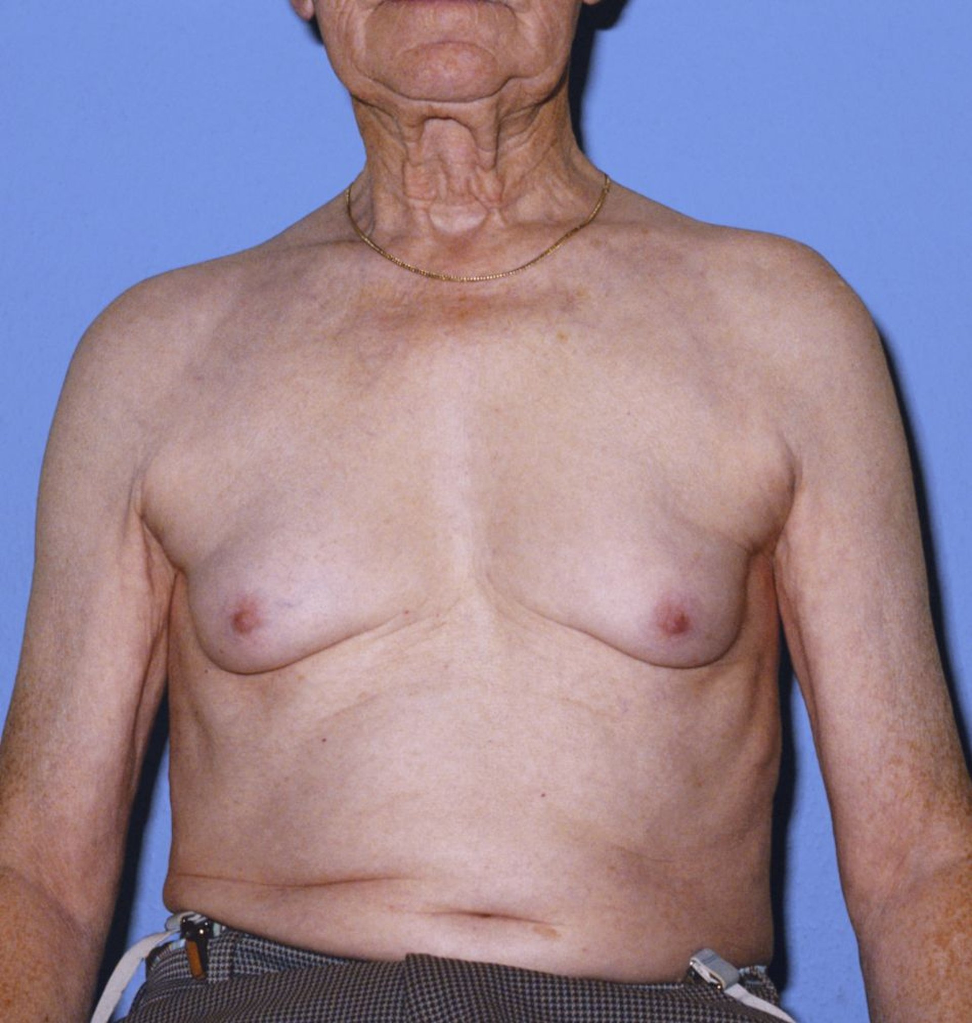 Gynecomastia