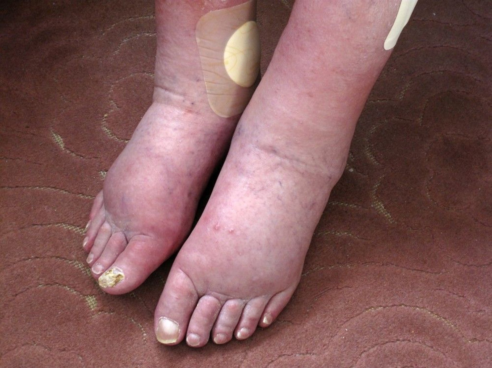 Lower Extremity Edema