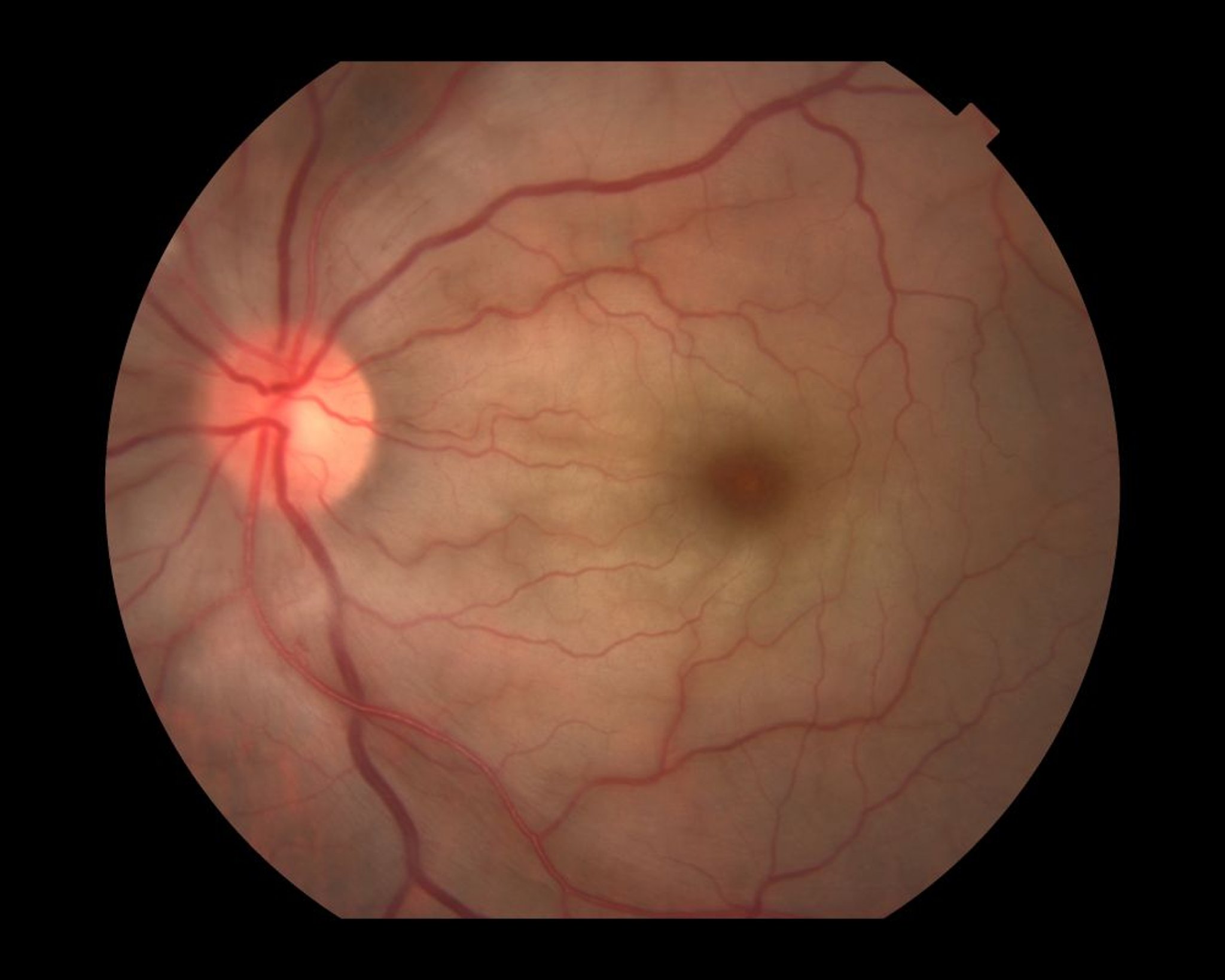 Oclusión de la arteria central de la retina