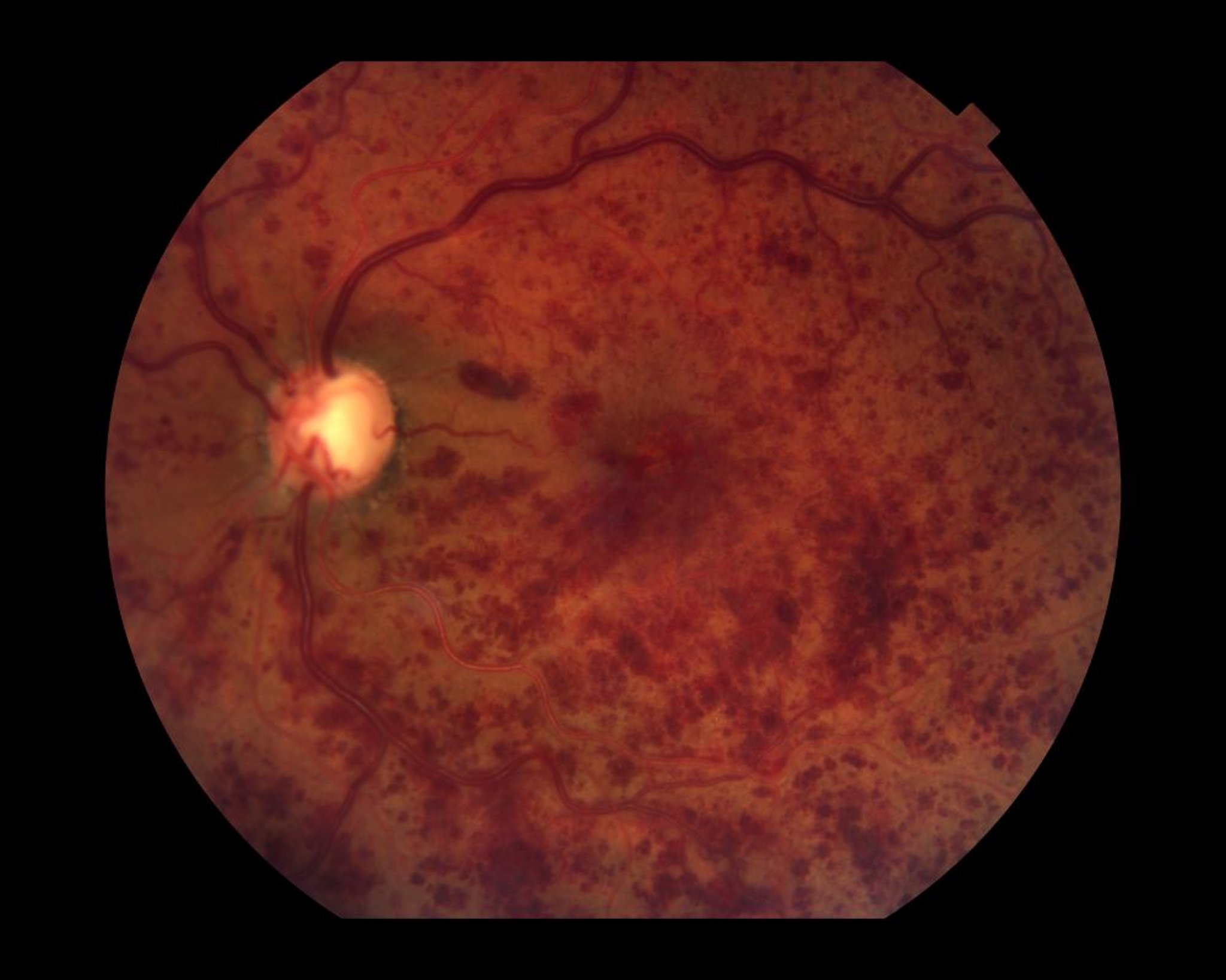 Oclusión de la vena central de la retina
