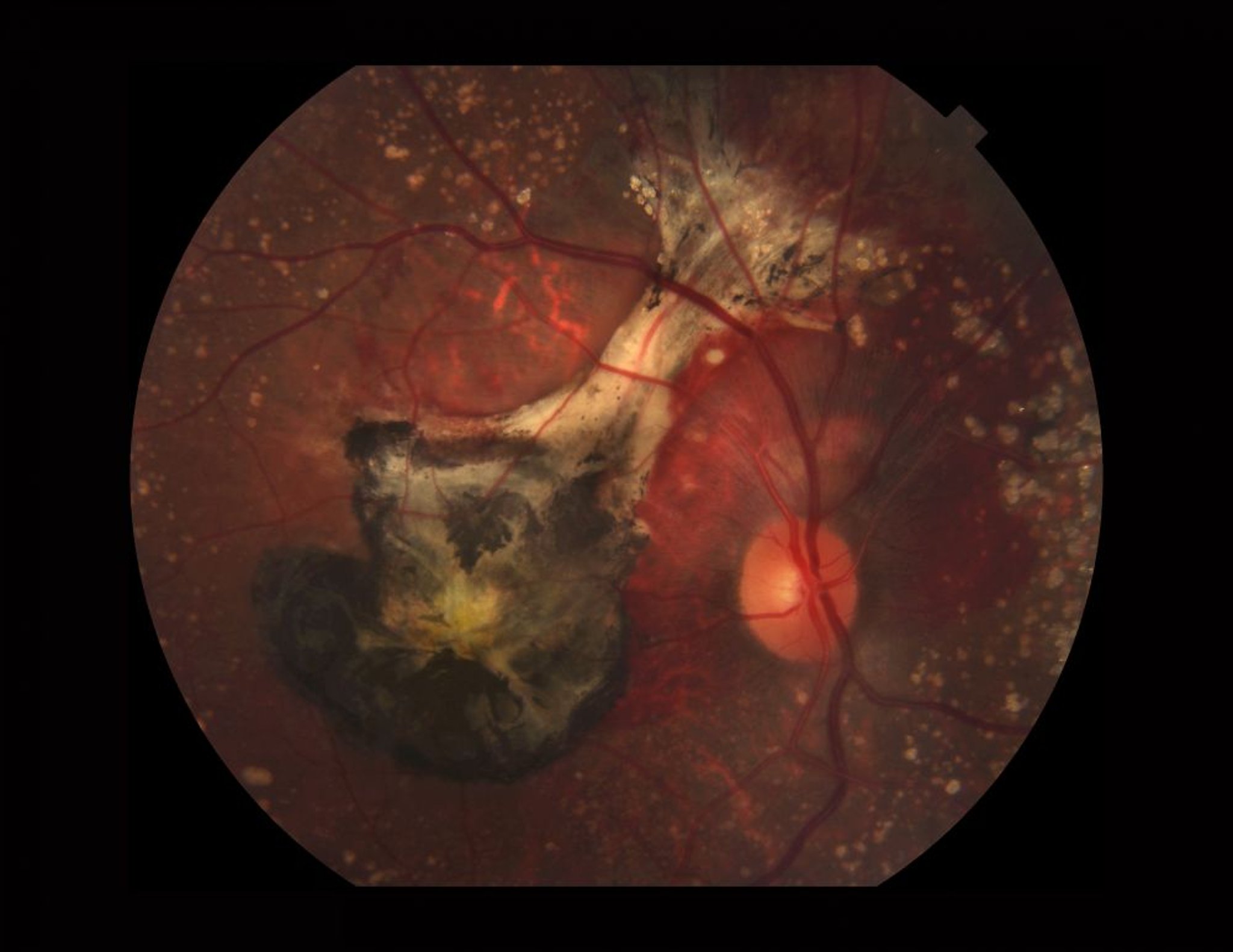 Degeneración macular relacionada con la edad (húmeda)