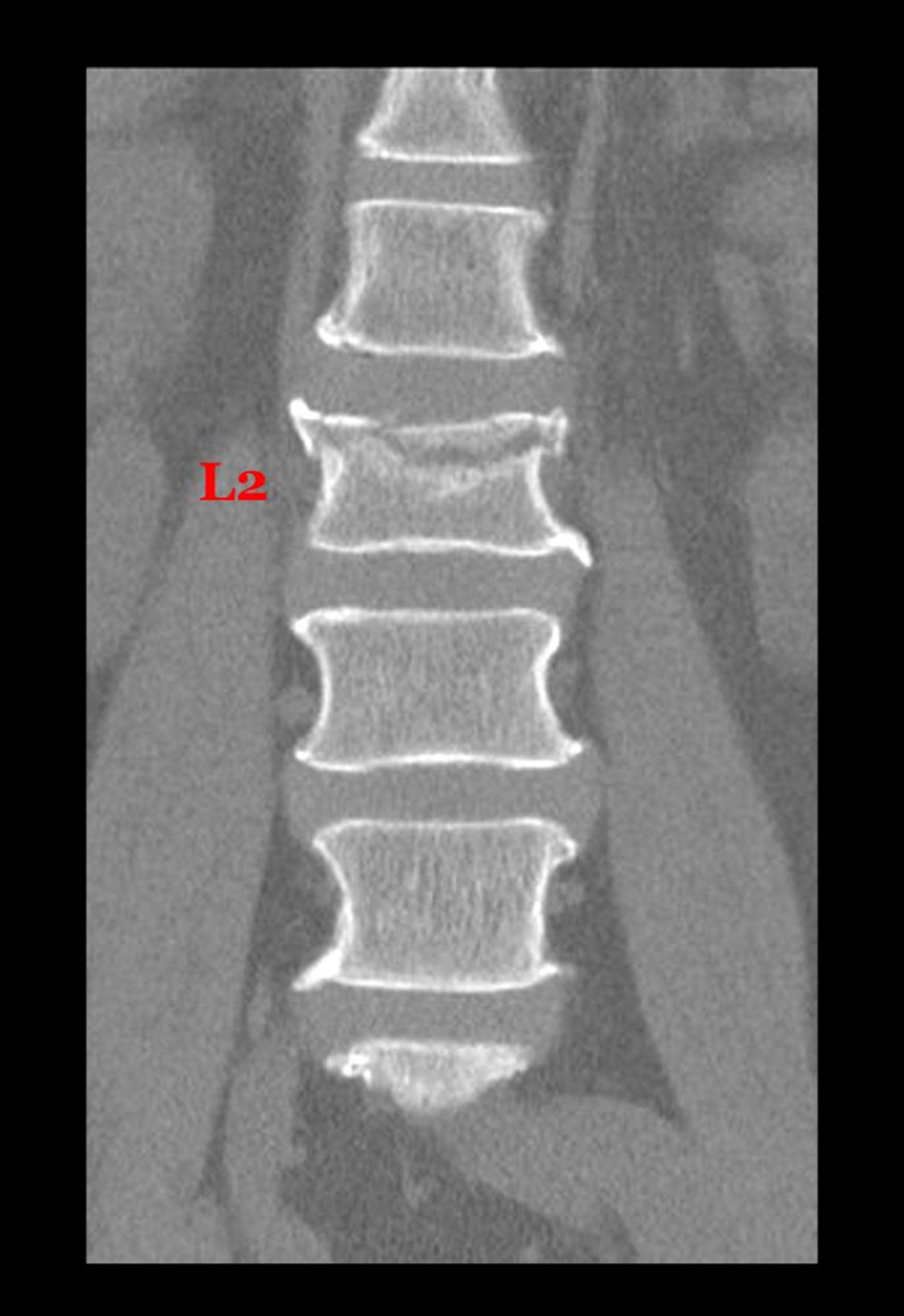 Fractura por compresión de una vértebra lumbar