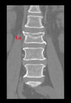 Frattura di una vertebra lombare da compressione
