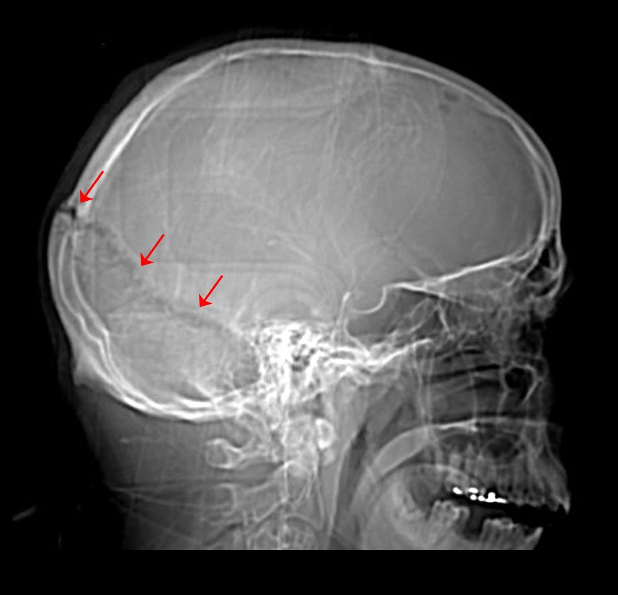 Fractura de cráneo