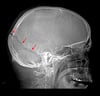 Fracture du crâne