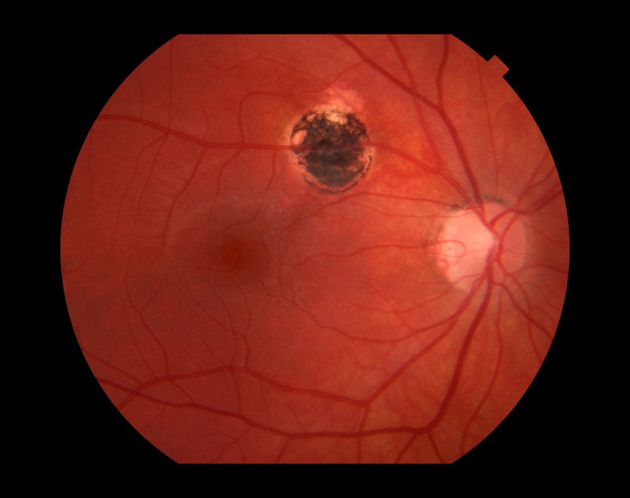 Retinitis (toxoplasmosis)