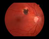 Retinitis (Toxoplasmosis)