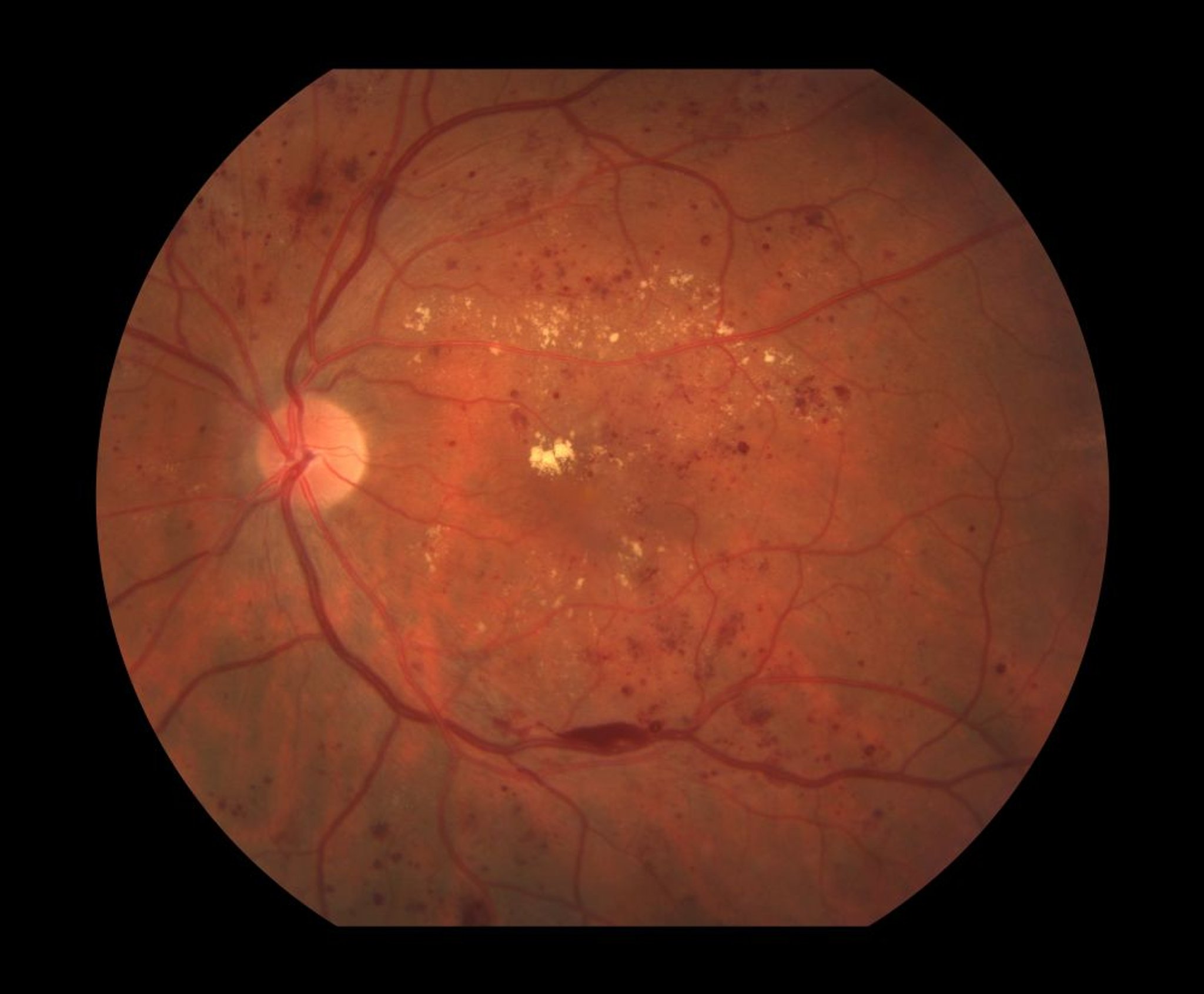 Diabetische Retinopathie (nichtproliferativ)