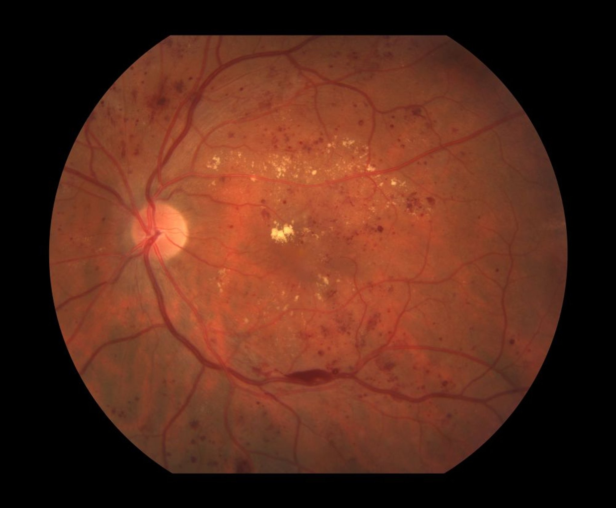 Диабетическая ретинопатия (непролиферативная)