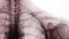 Fracture de la clavicule