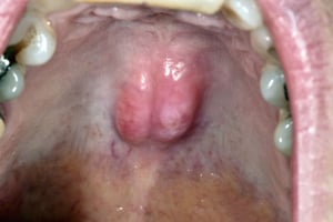Lồi xương hàm trên