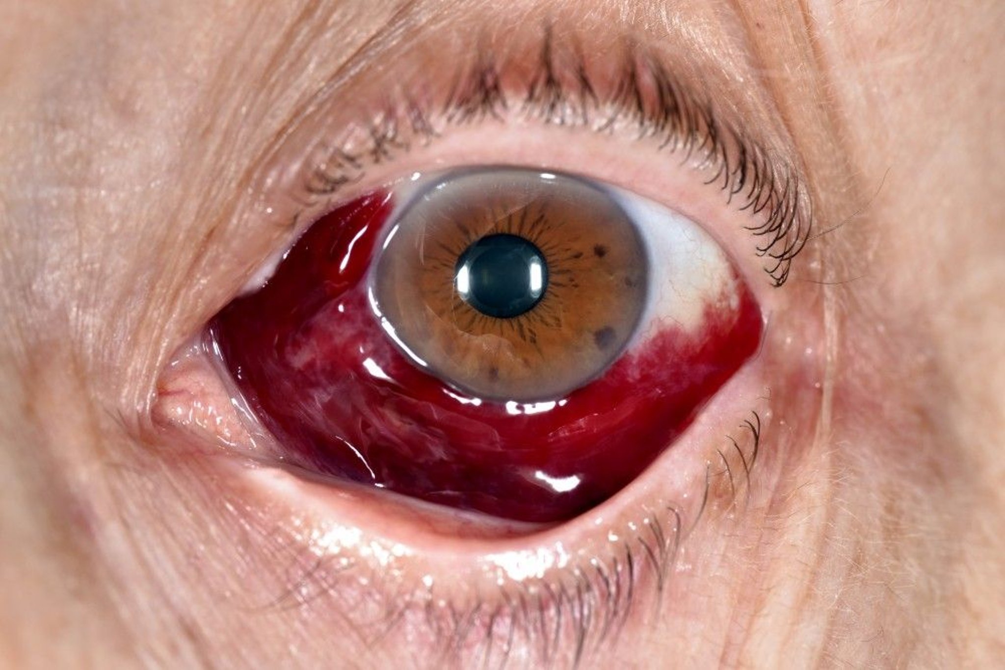 Subconjunctival Hemorrhage