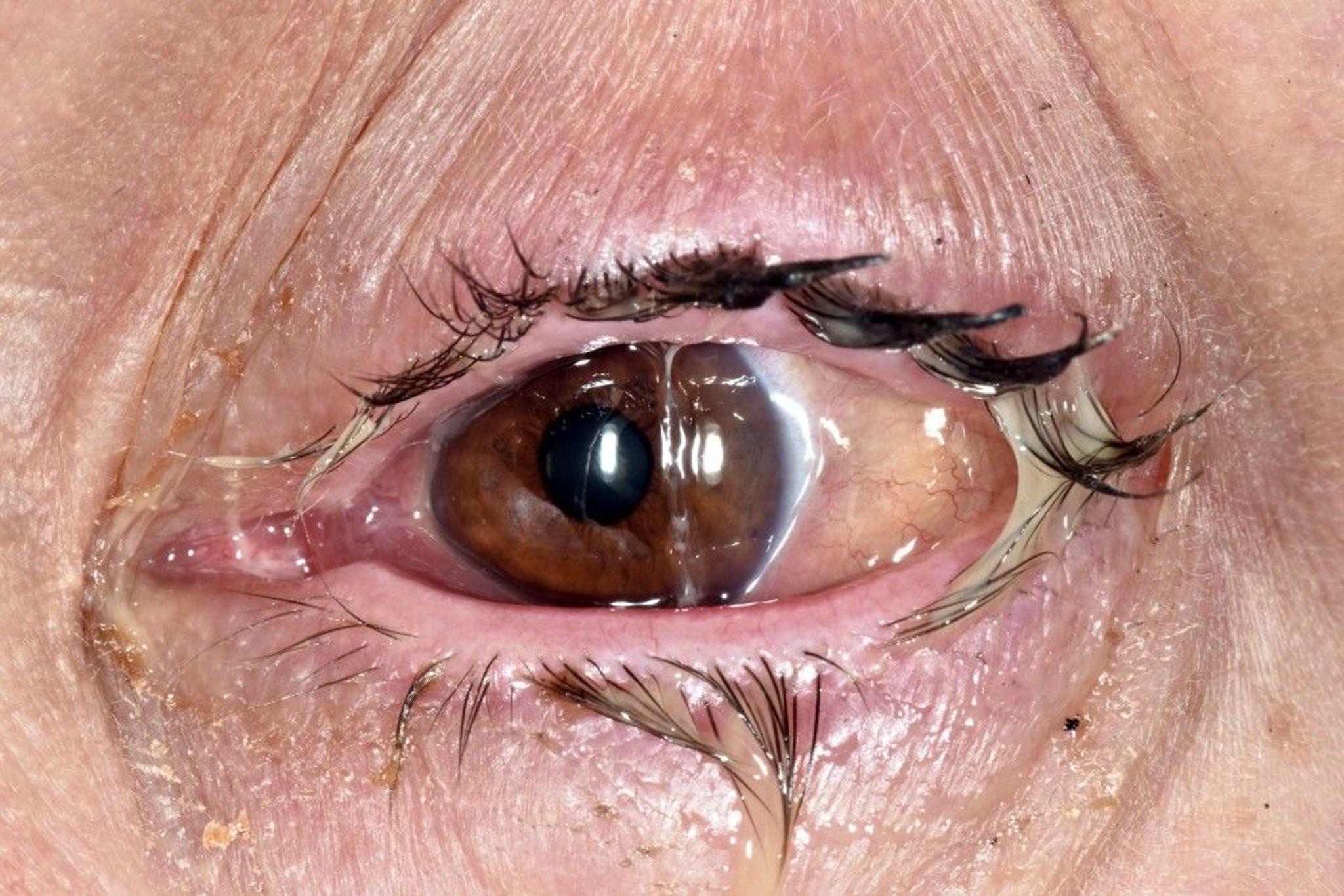 Bacterial Conjunctivitis