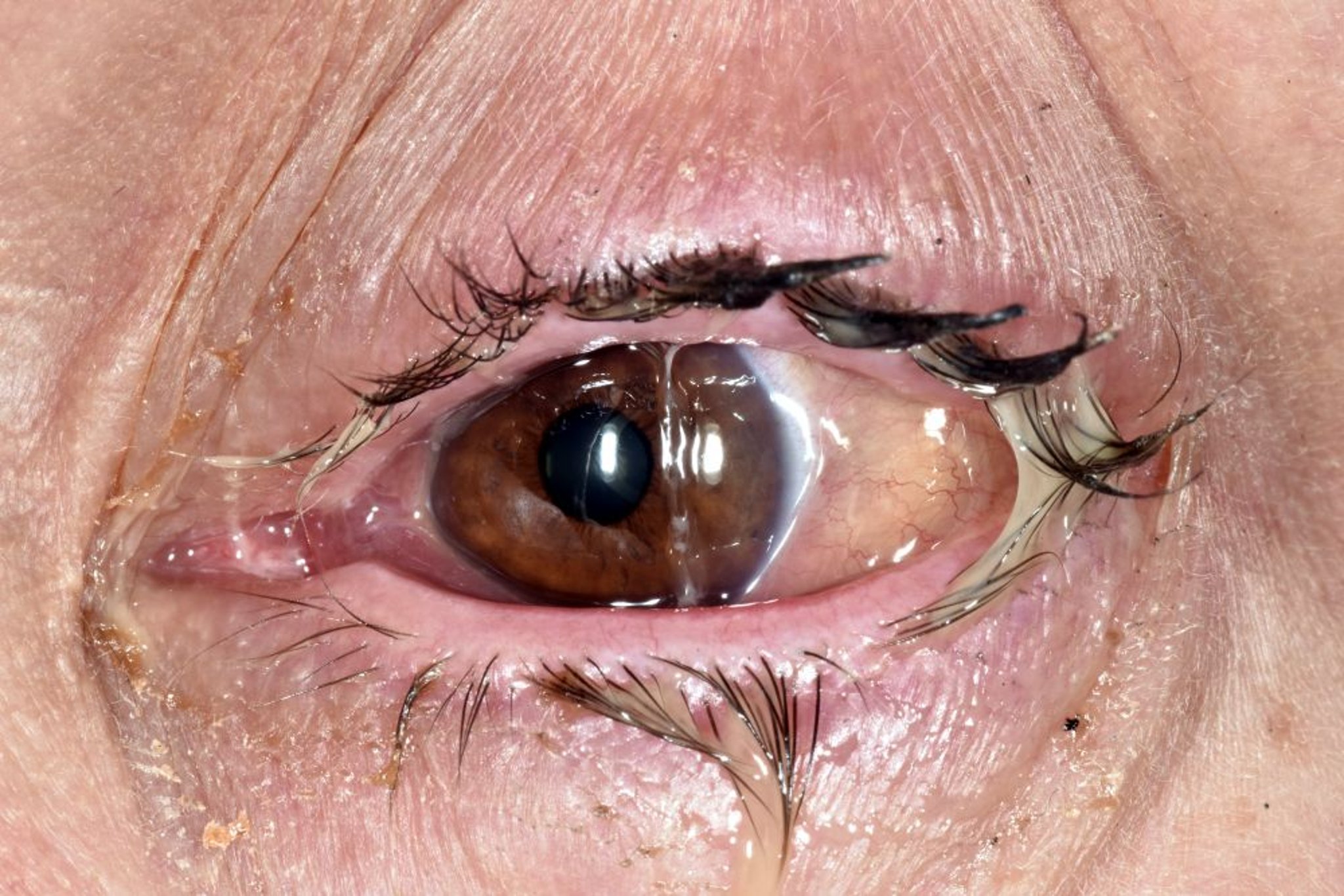 Conjuntivitis bacteriana