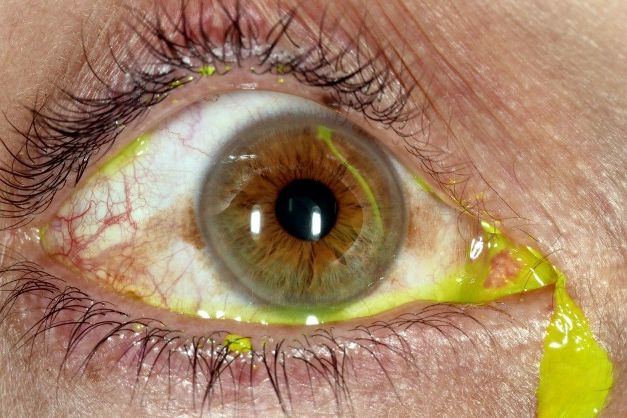 Corneal Abrasion