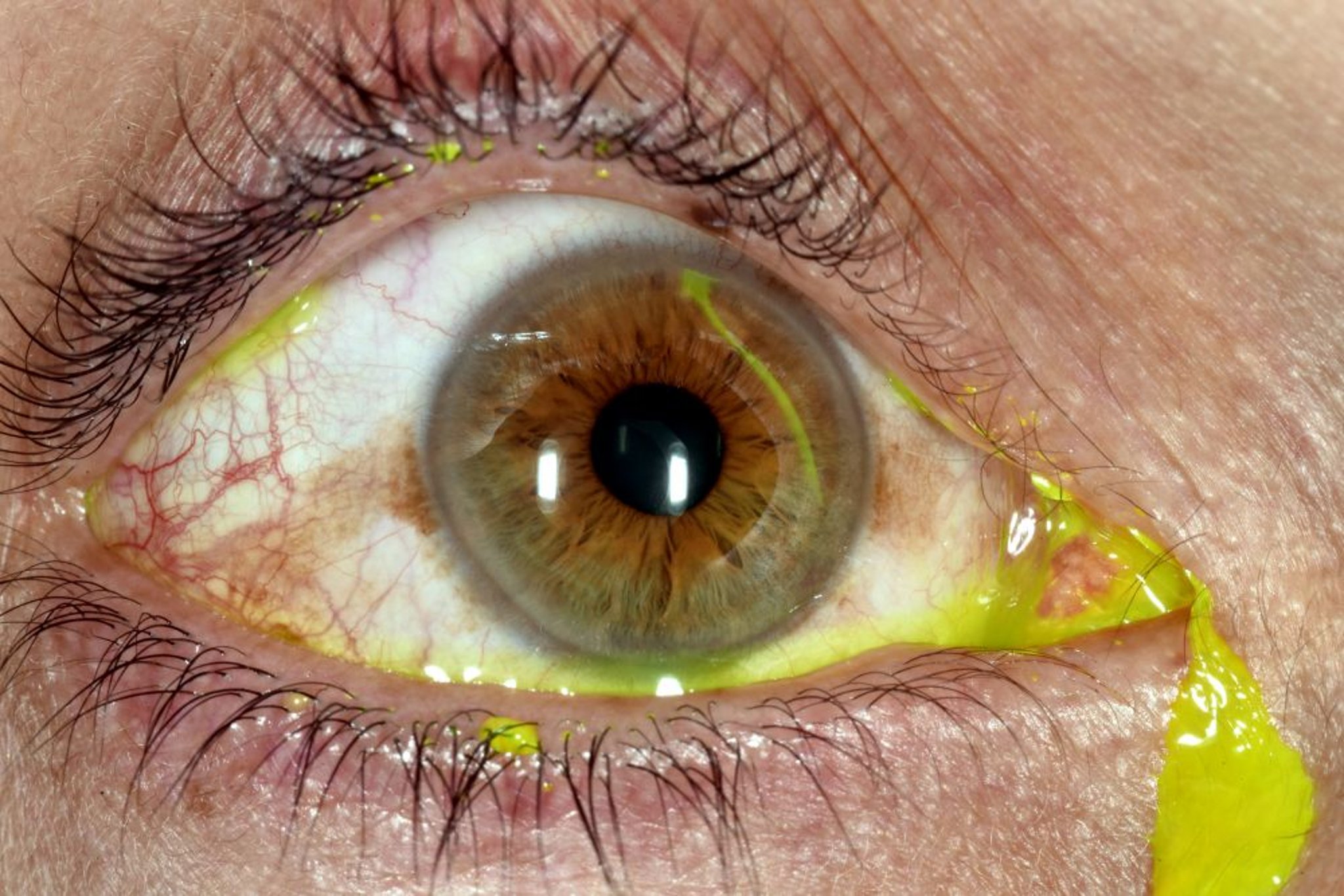 Abrasión corneal