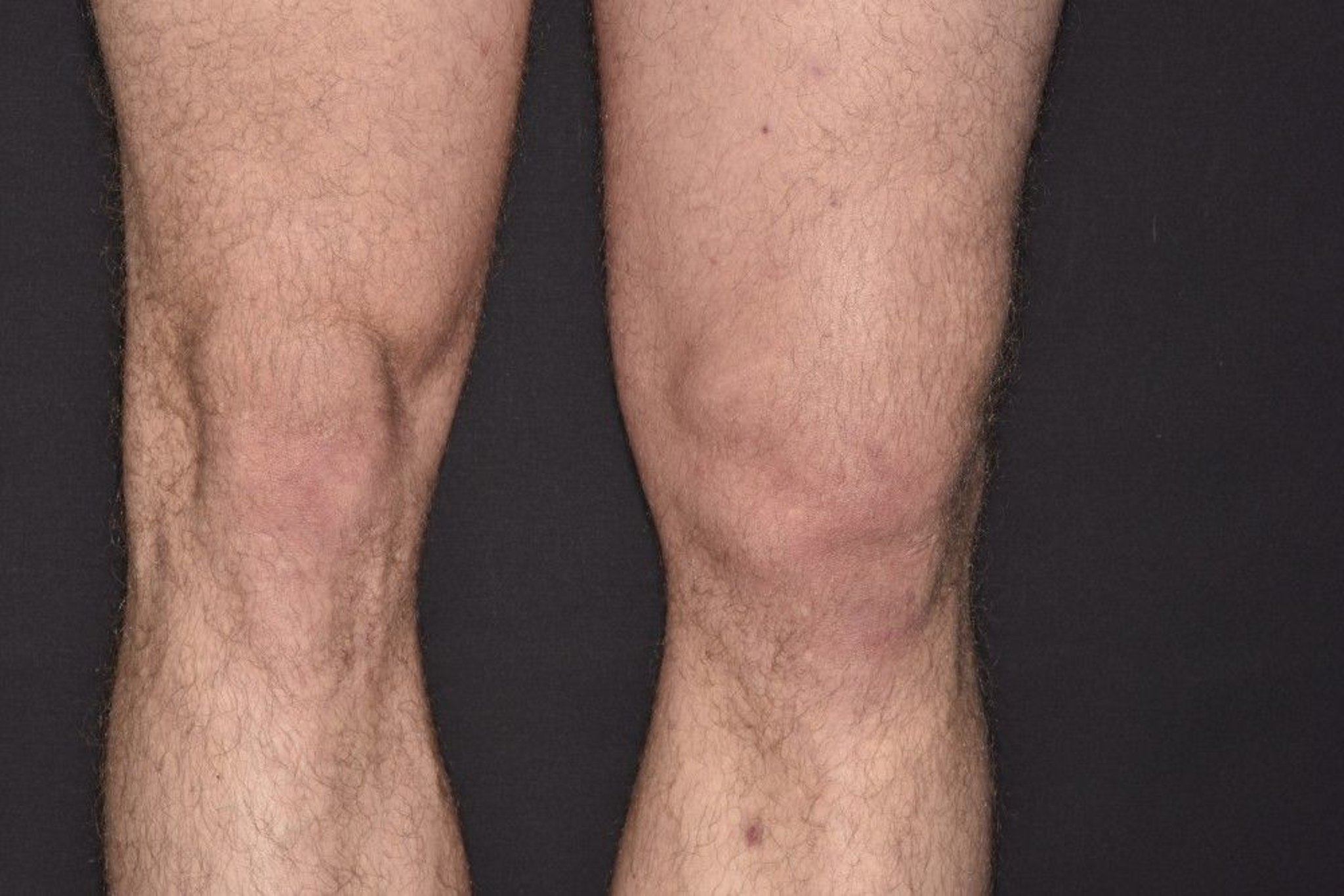 Patellar Dislocation