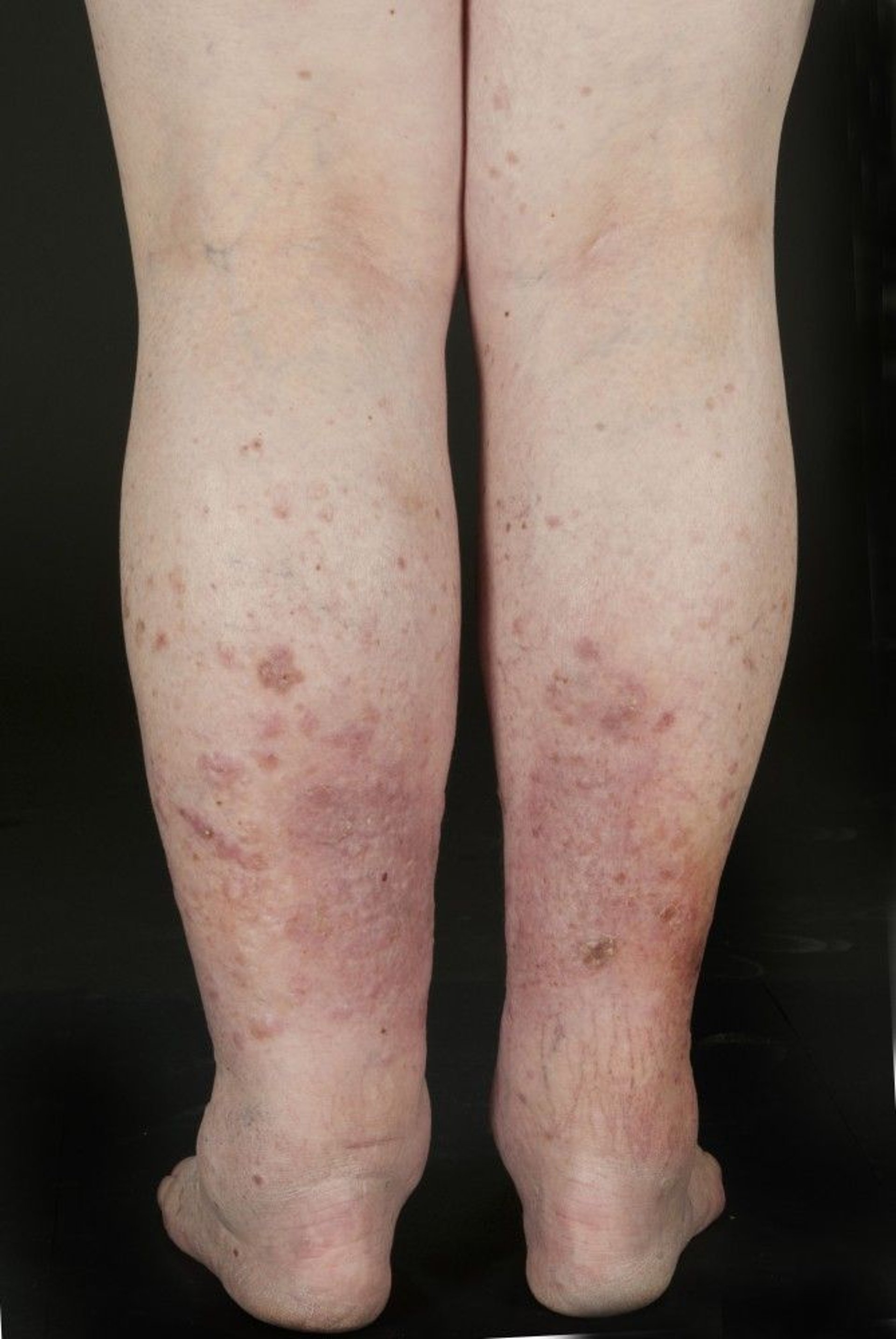 Squamous Cell Carcinoma in Situ (Multiple Lesions)