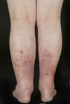Carcinome malpighien in situ (lésions gingivales)